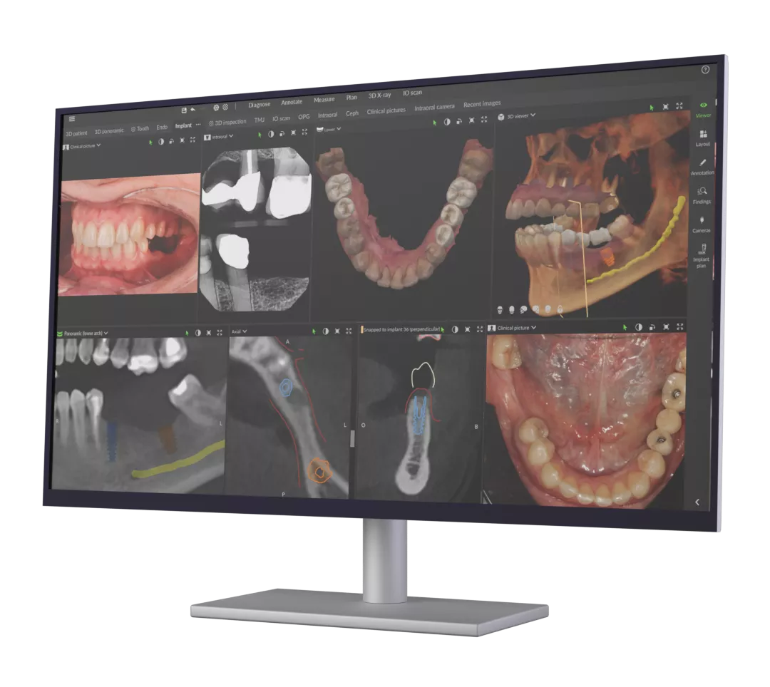 autre vue scanner 3D