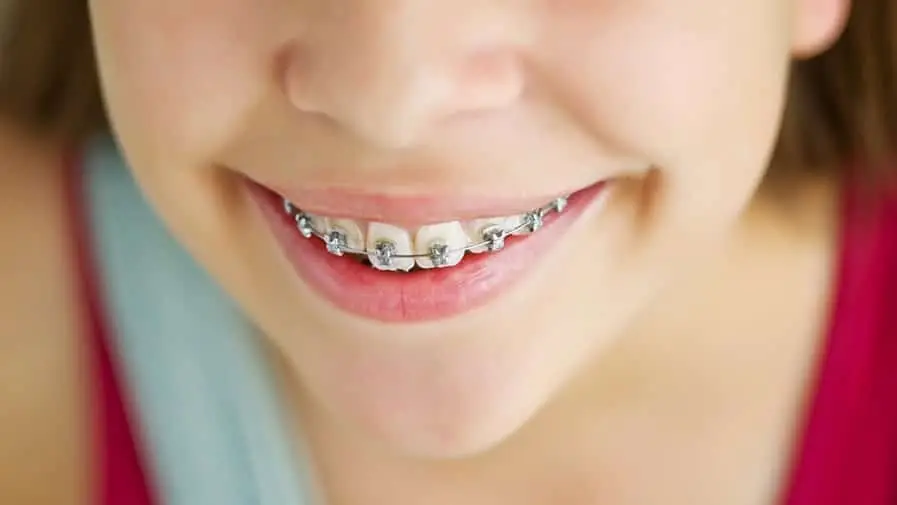 Orthodontie enfant